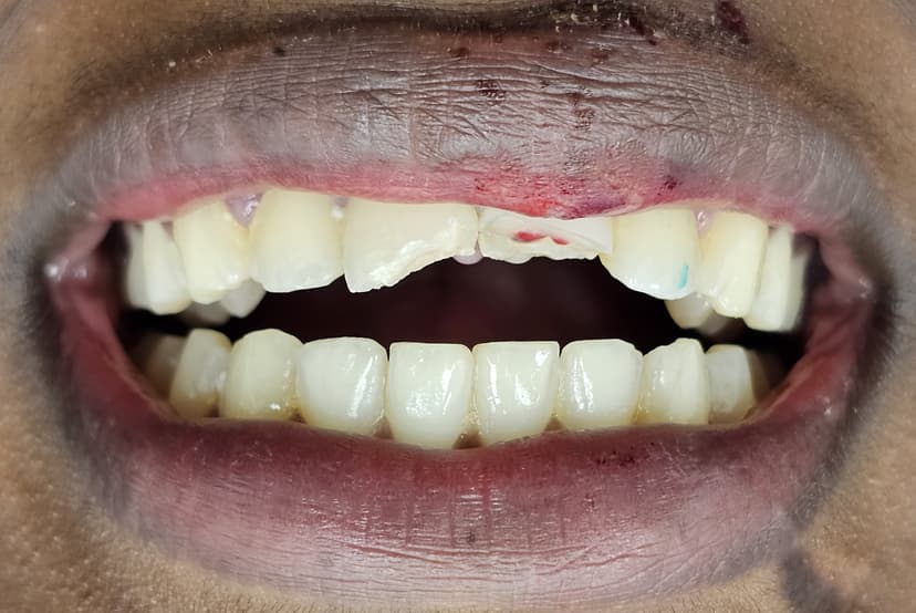 broken tooth before treatment