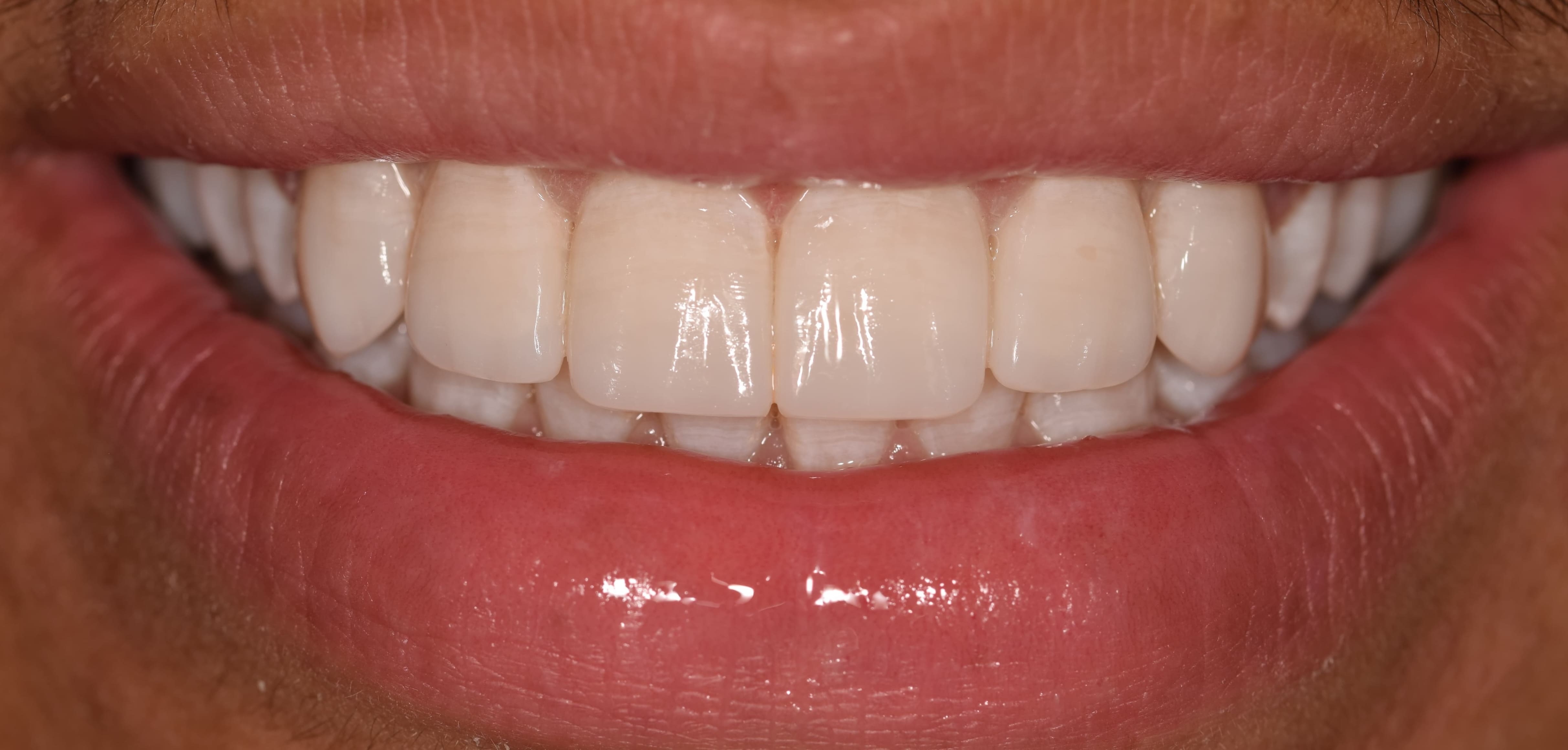 Before and After Porcelain Veneers Smile Restoration